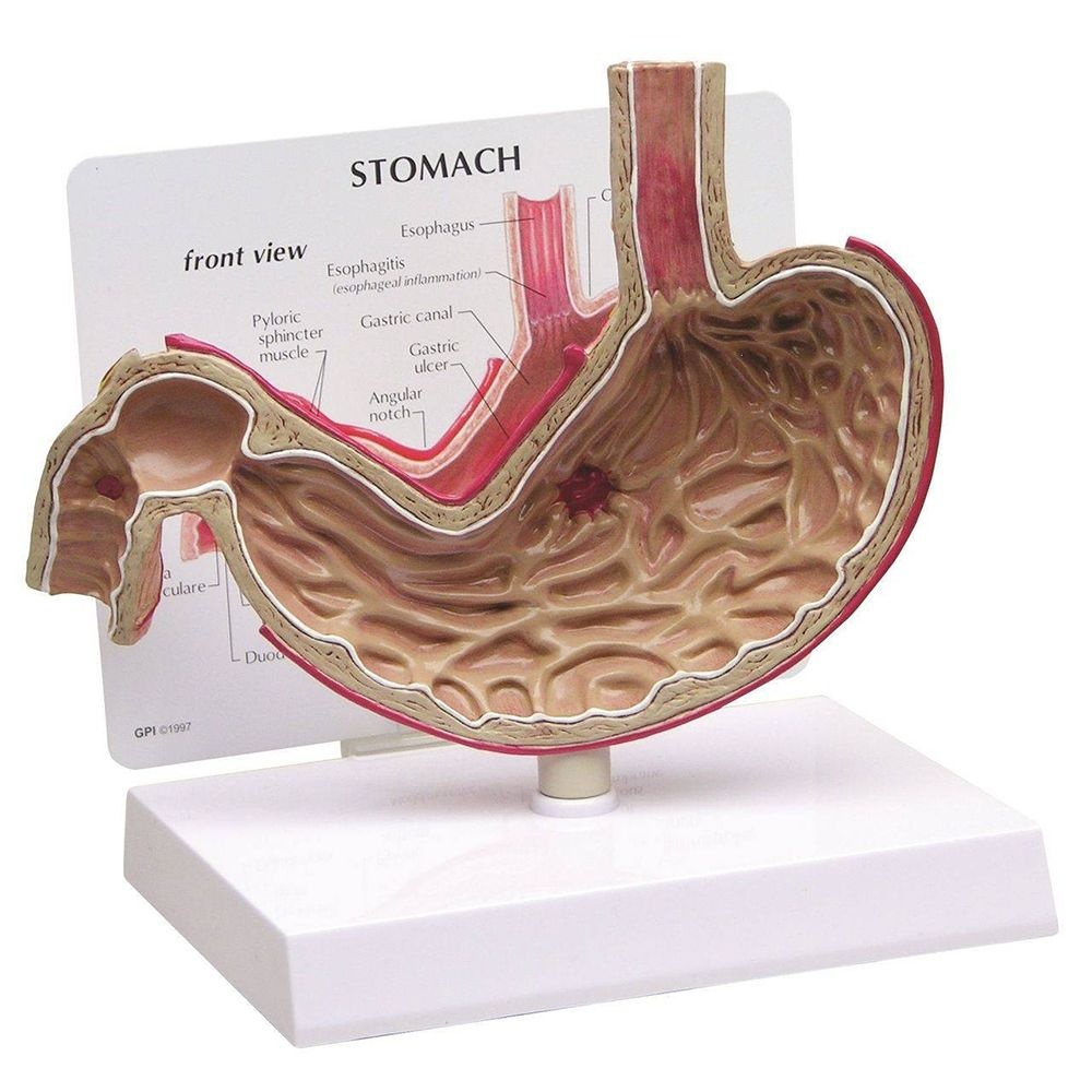 [오늘출발] 종로의료기상사 GPI USA 위 해부모형 G200 위궤양모형 위병변 Stomach With Ulcers